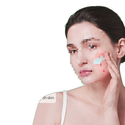 Herbal Acne Face Cream for Blemish and Scar Care Daily Use