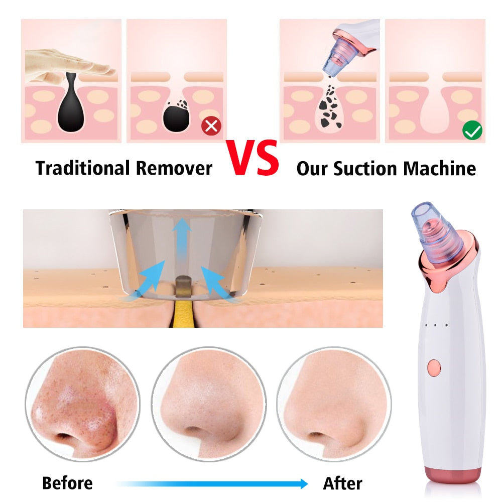 Buy Blackhead Pore Vacuum Cleaner – Suction Face Tool for Clear Skin