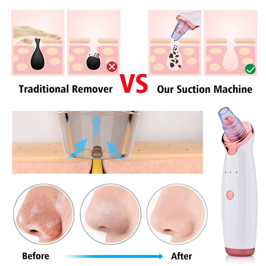 Buy Blackhead Pore Vacuum Cleaner – Suction Face Tool for Clear Skin