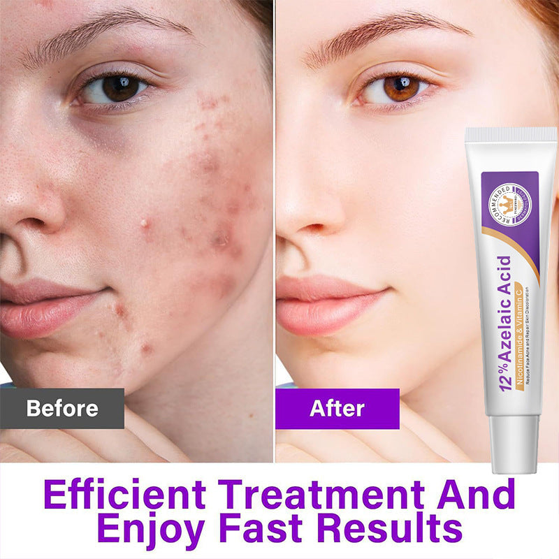 15% Azelaic Acid Serum to Reduce Acne Scars and Marks