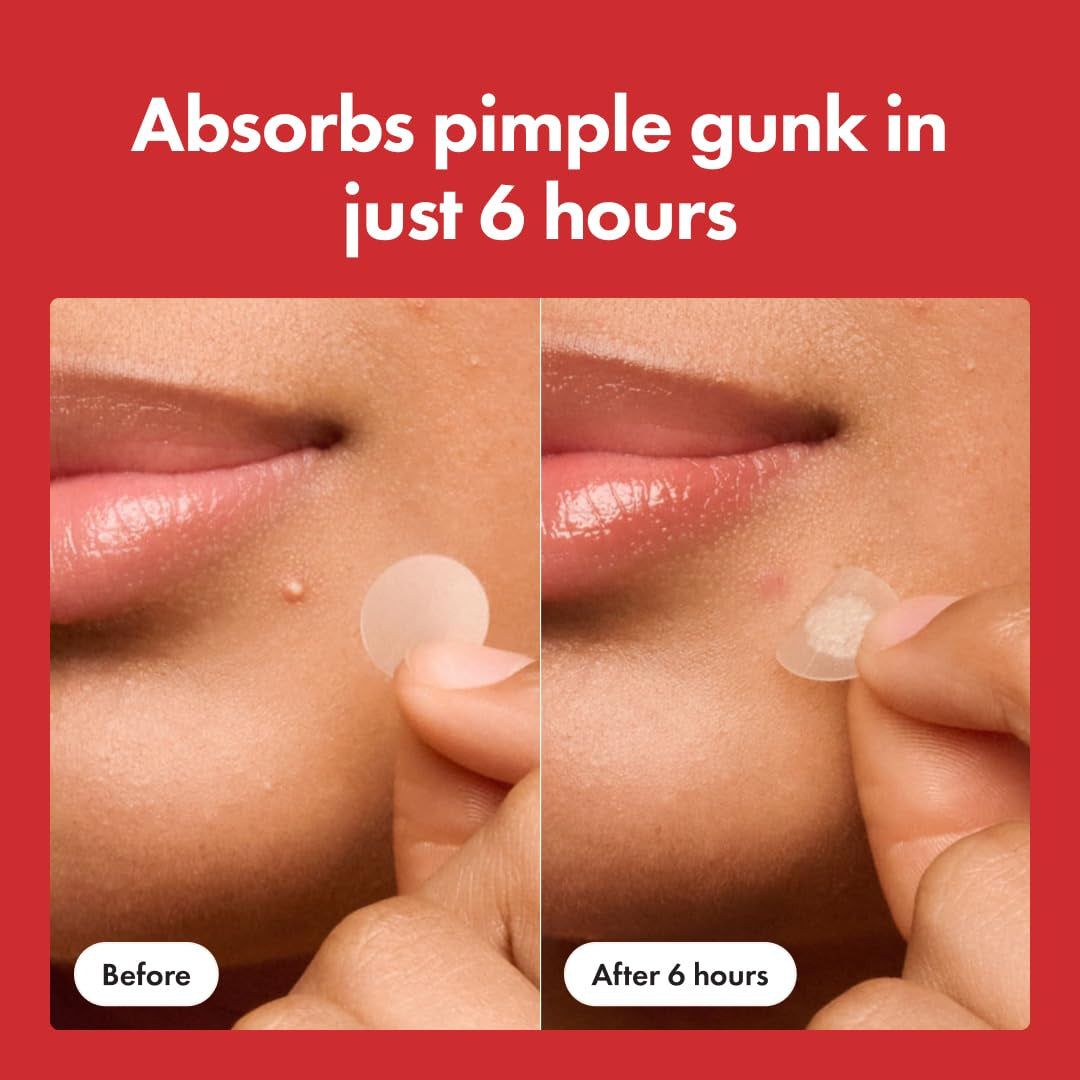 Pimple Patch for Acne Spot Care and Clear Skin Treatment Use globalswanky 02