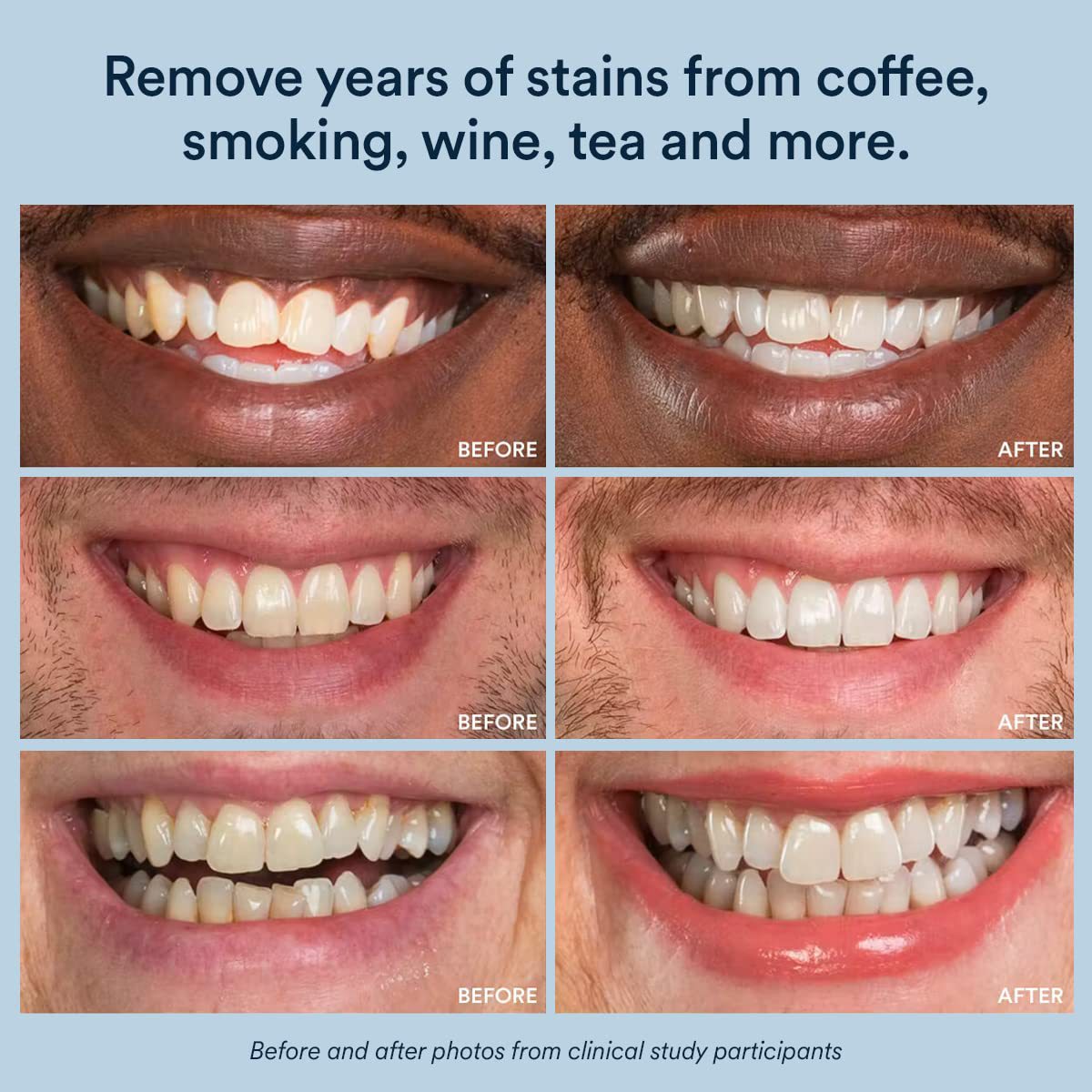 Teeth Whitening Strips with Enamel Repair Dental Care Kit globalswanky 02