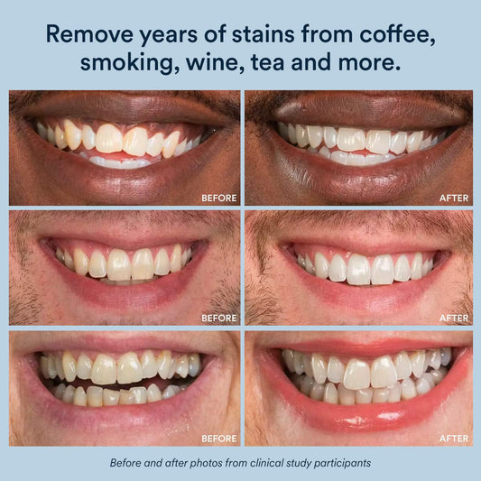 Teeth Whitening Strips with Enamel Repair Dental Care Kit globalswanky 02