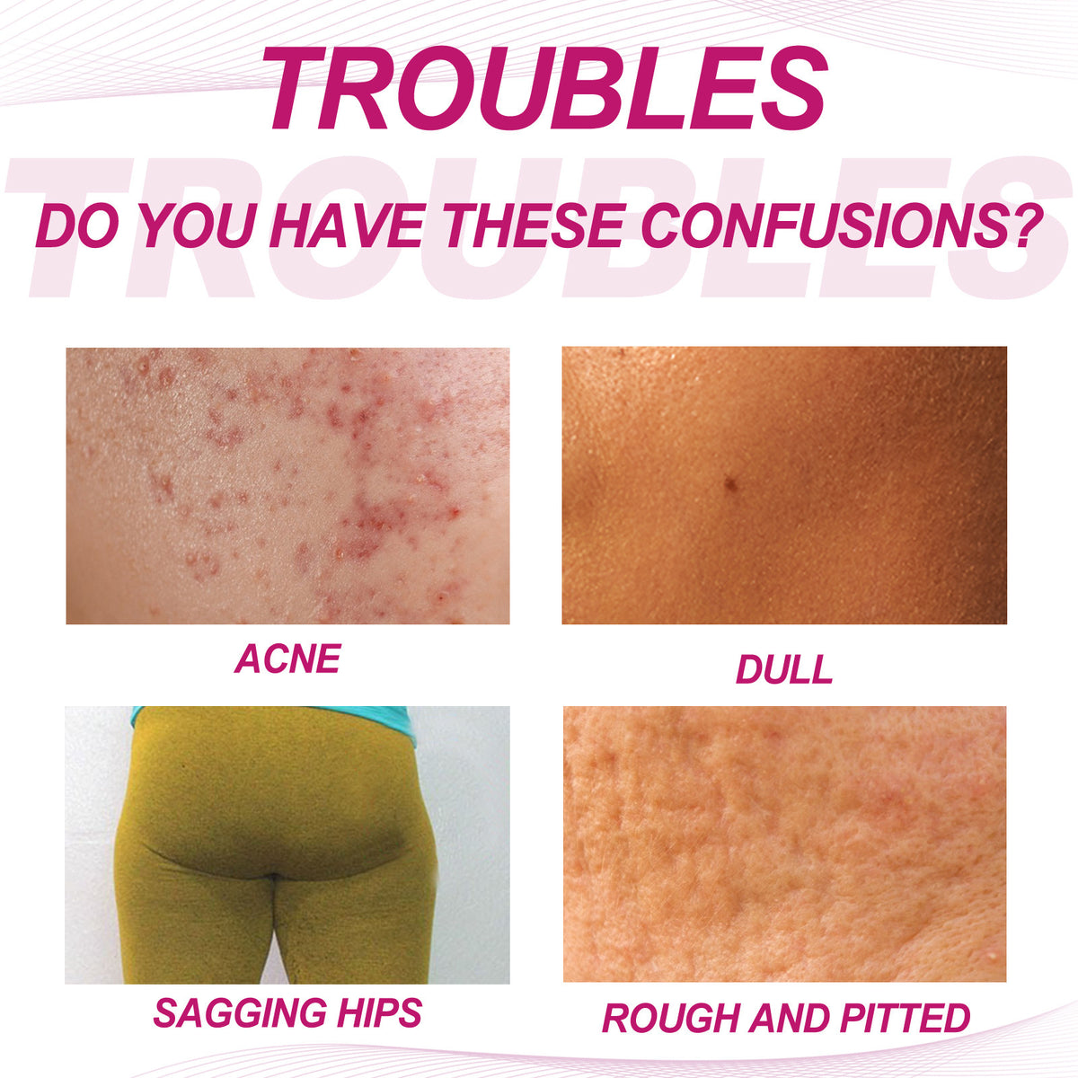 Acne Clearing Cream