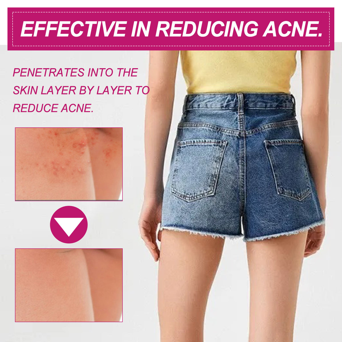 Acne Clearing Cream