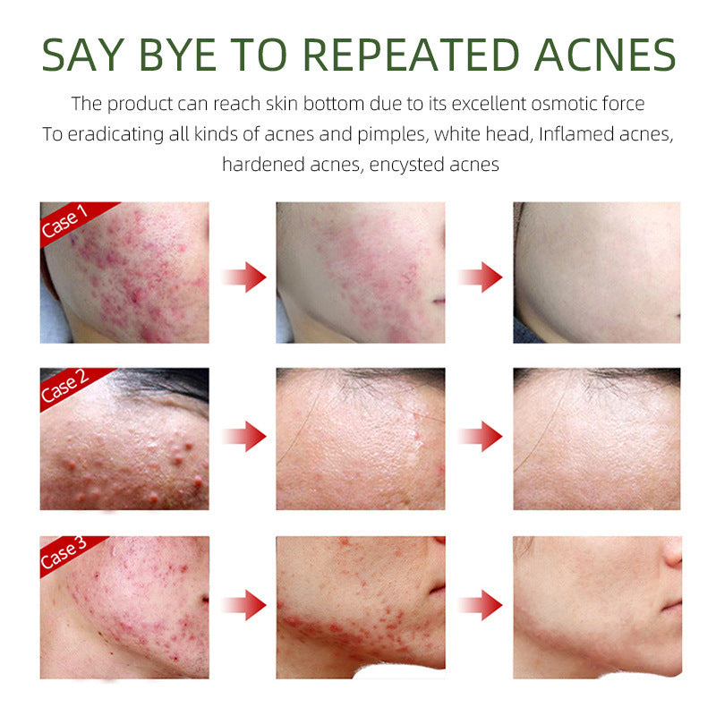 Acne Repair Cream