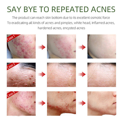 Acne Repair Cream