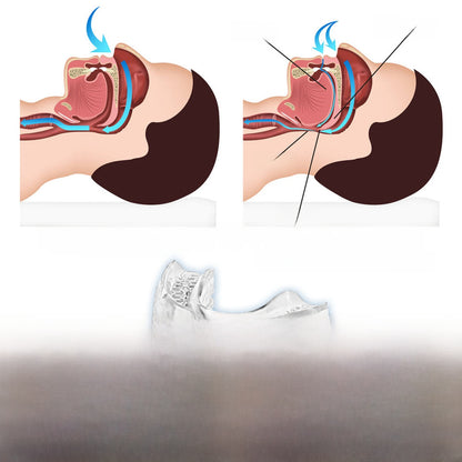 Anti Snoring Braces