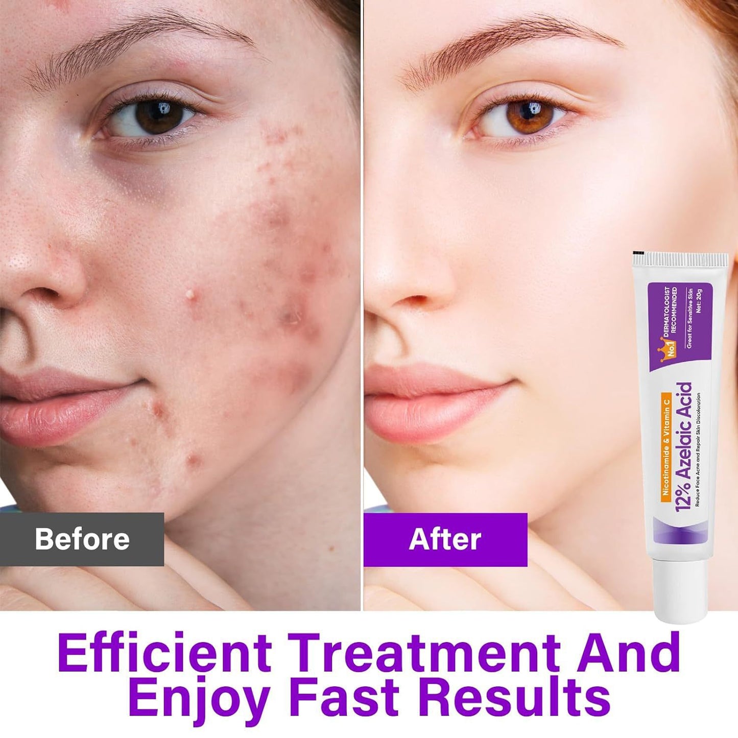 Azelaic Acid Gel