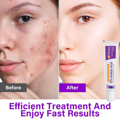 Azelaic Acid Gel