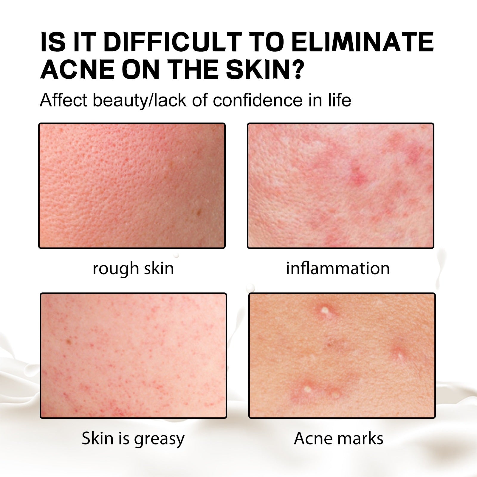 Deep Cleansing, Acne-Treating, and Moisturizing Soap