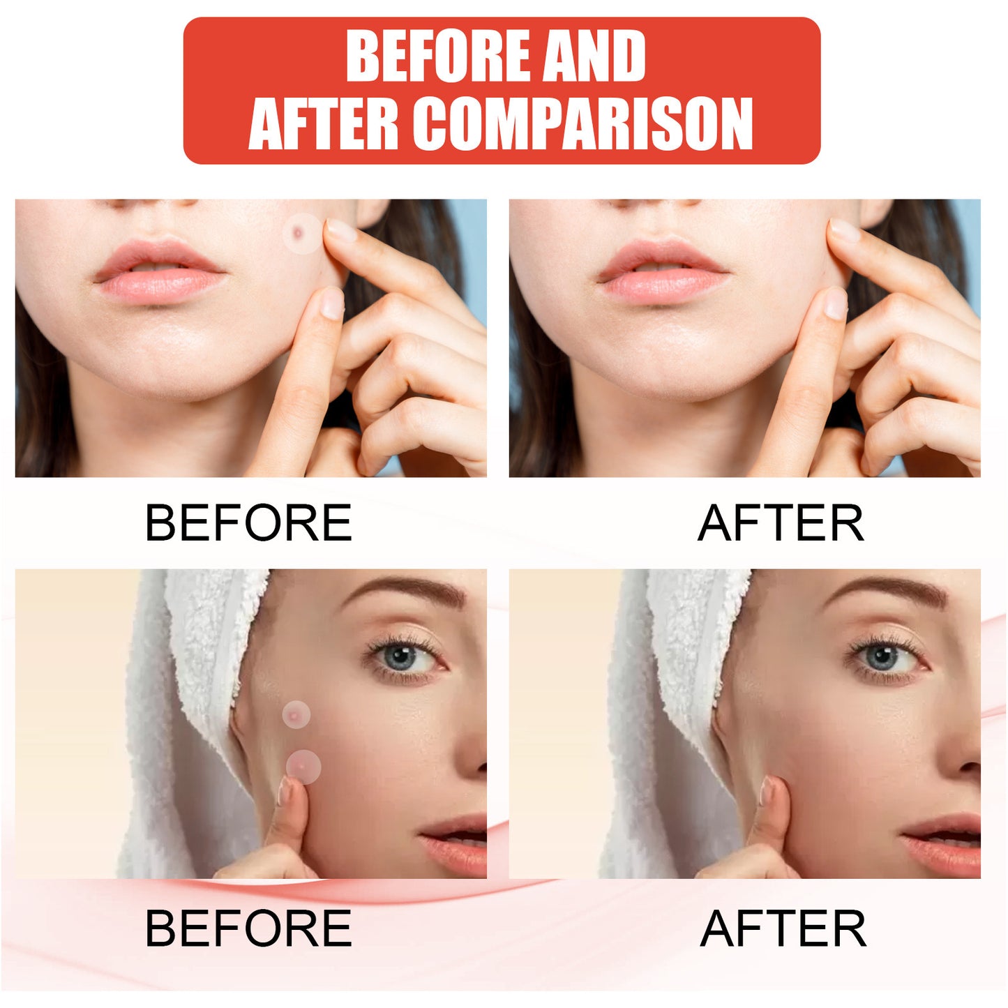 EELHOE Hydrocolloid Acne Patches