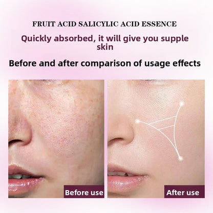 Fruit Acid Salicylic Acid Essence
