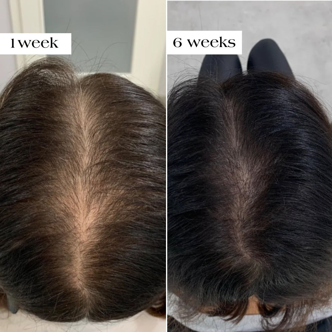 Hair Micro-Needle Growth Essence Set