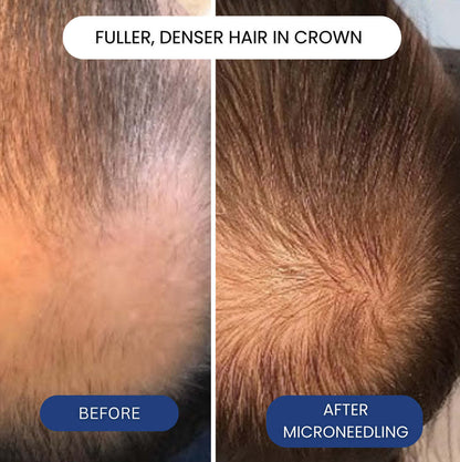Hair Regrowth Micro-Needle Essence Liquid