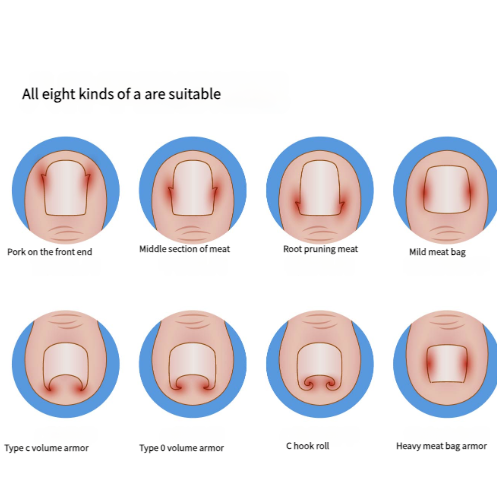 Ingrown Toenail Corrector