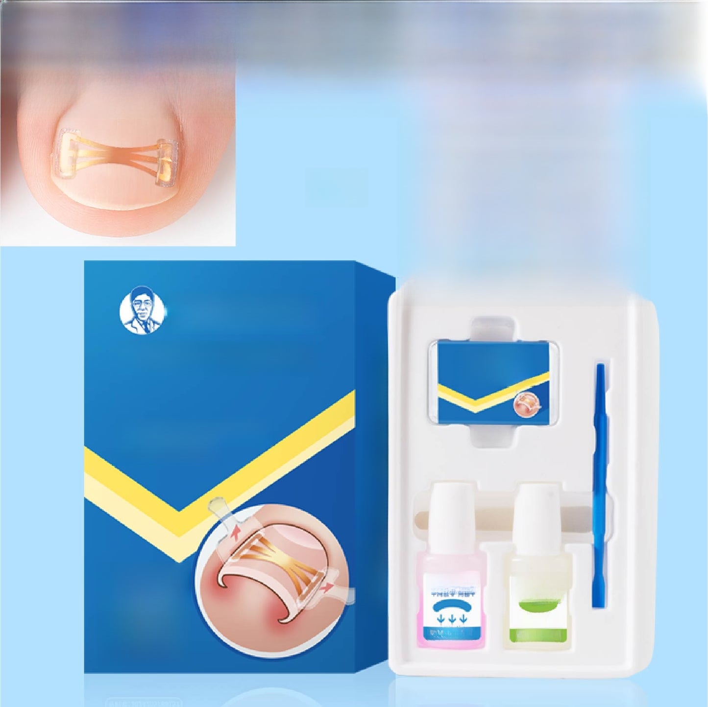 Ingrown Toenail Corrector