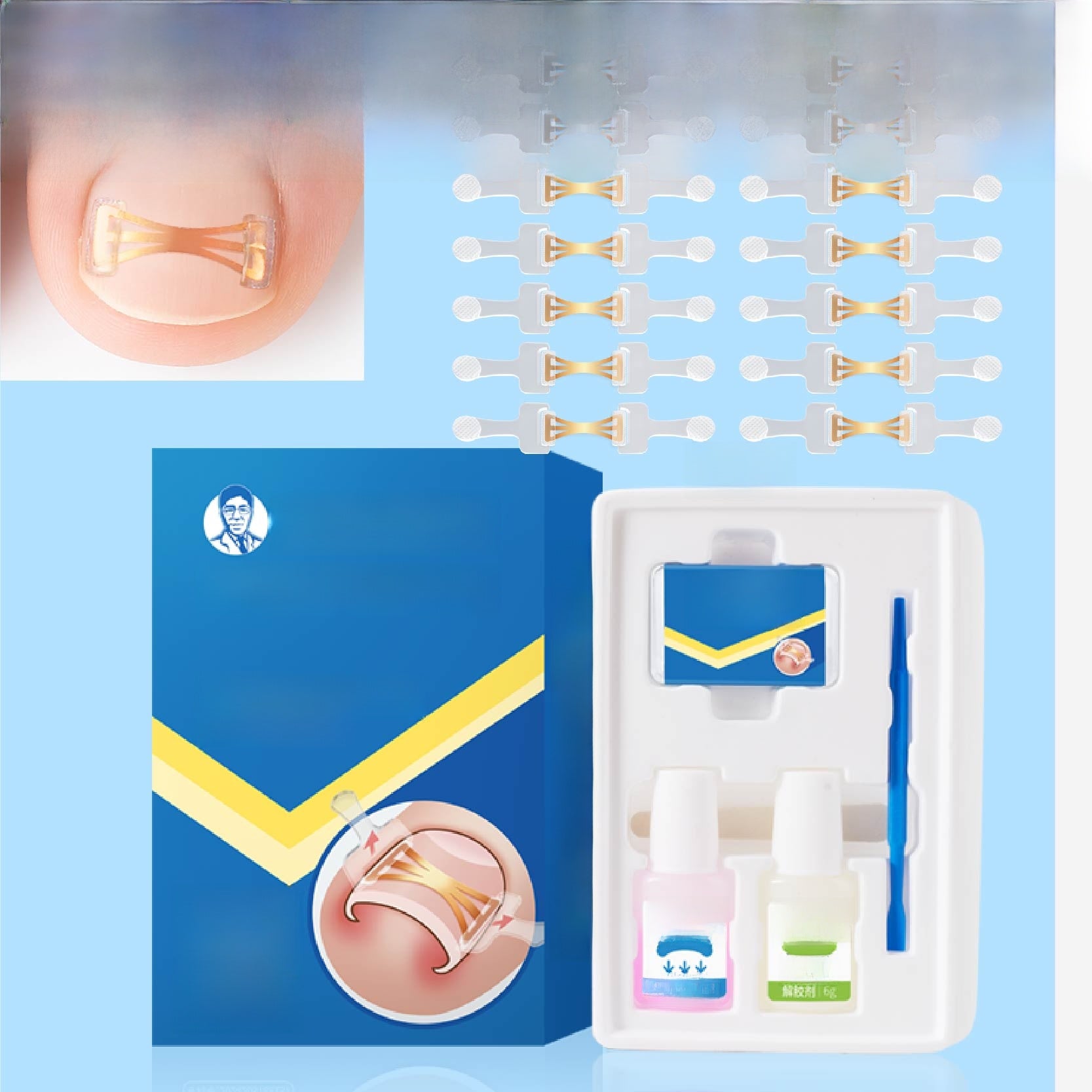 Ingrown Toenail Corrector