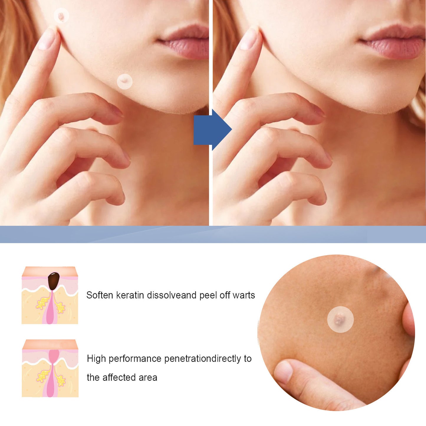 Invisible Acne Protection Patches