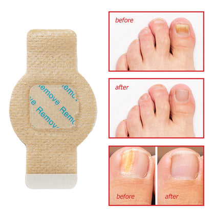 Nail Antibacterial Patch