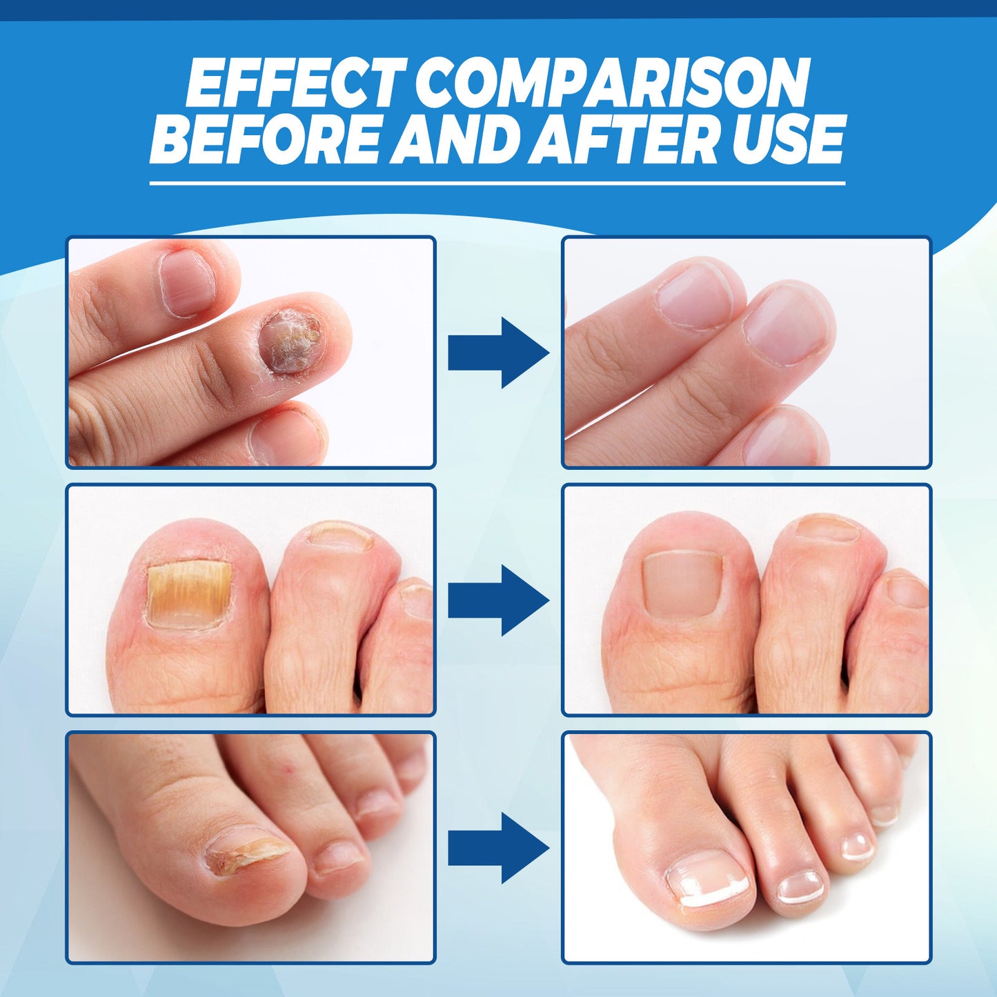 Onychomycosis Repair Laser Pen