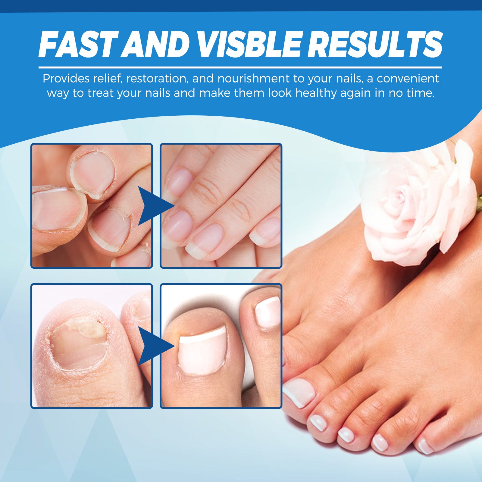 Onychomycosis Repair Laser Pen