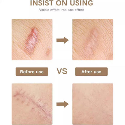 Reusable Silicone Scar Tape for Skin Repair