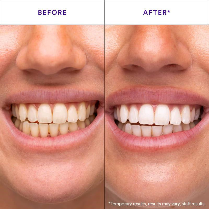 Teeth Whitening Strips