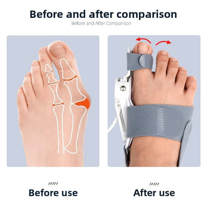 Thumb Toe Correction Orthotic Adjustable Device