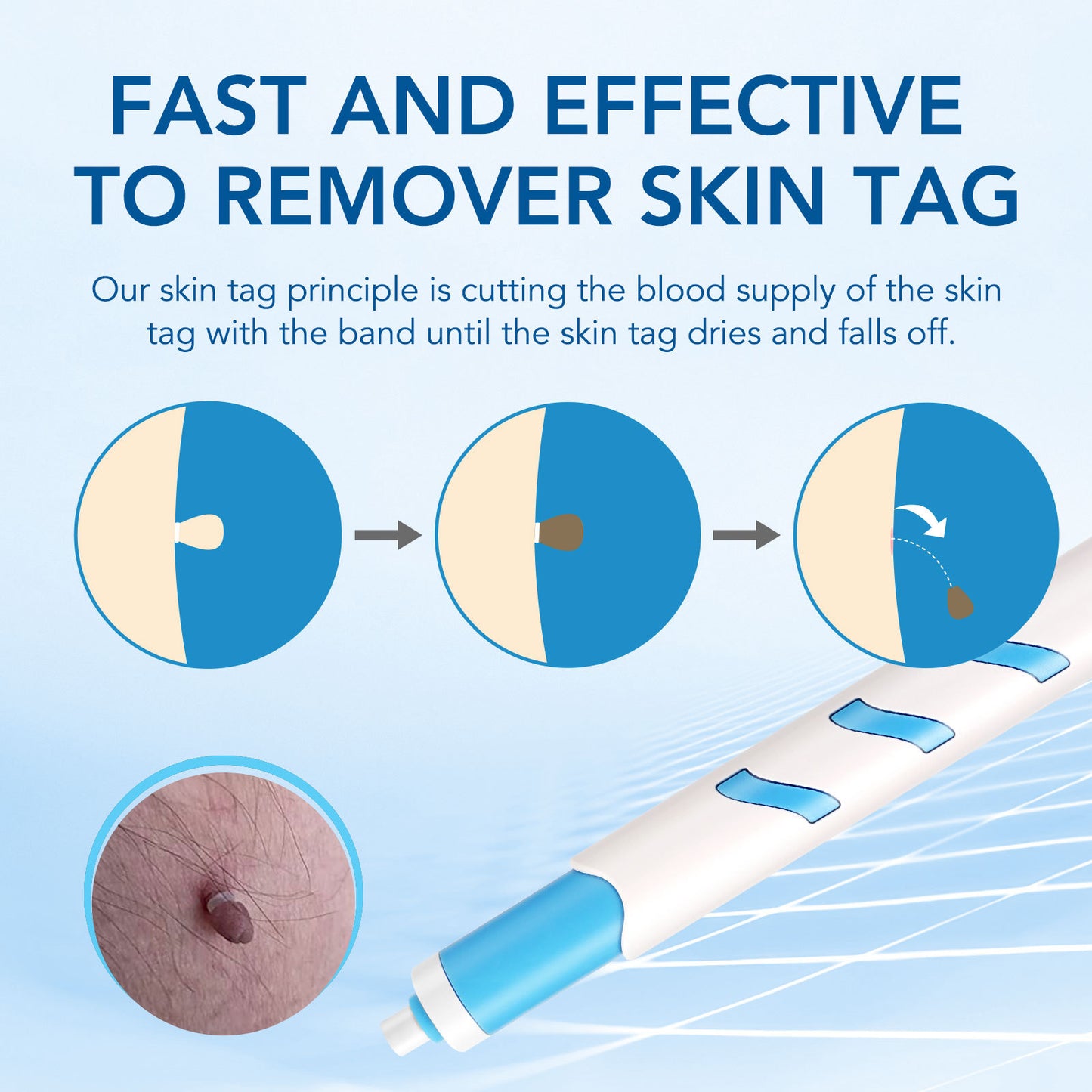 wart removal pen