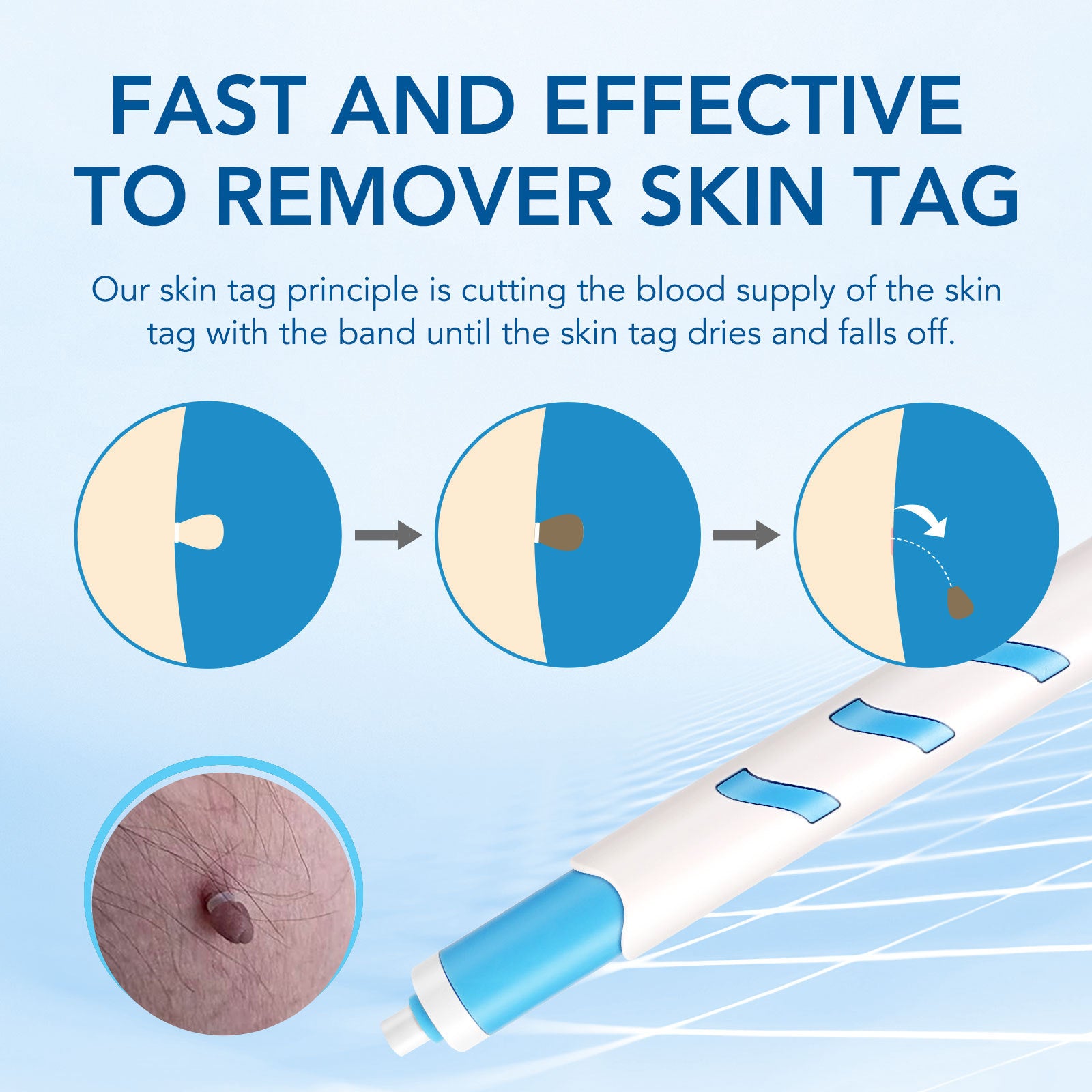 wart removal pen